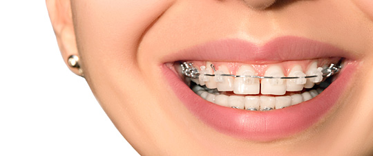 Braces - Level Orthodontics